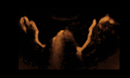 Kinderwunschbehandlung Ultraschallkontrastuntersuchung